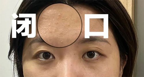 闭口粉刺形成的原因有哪些？