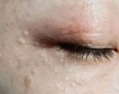 脂肪粒怎么样才能去除？去除脂肪粒的方法